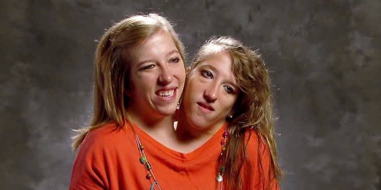 Abigail and Brittany Hensel biography 